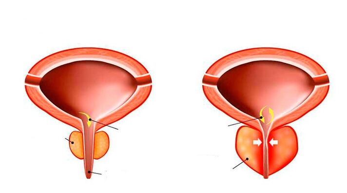 The prostate is normal and inflamed