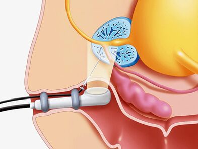 The biopsy of the prostate gland
